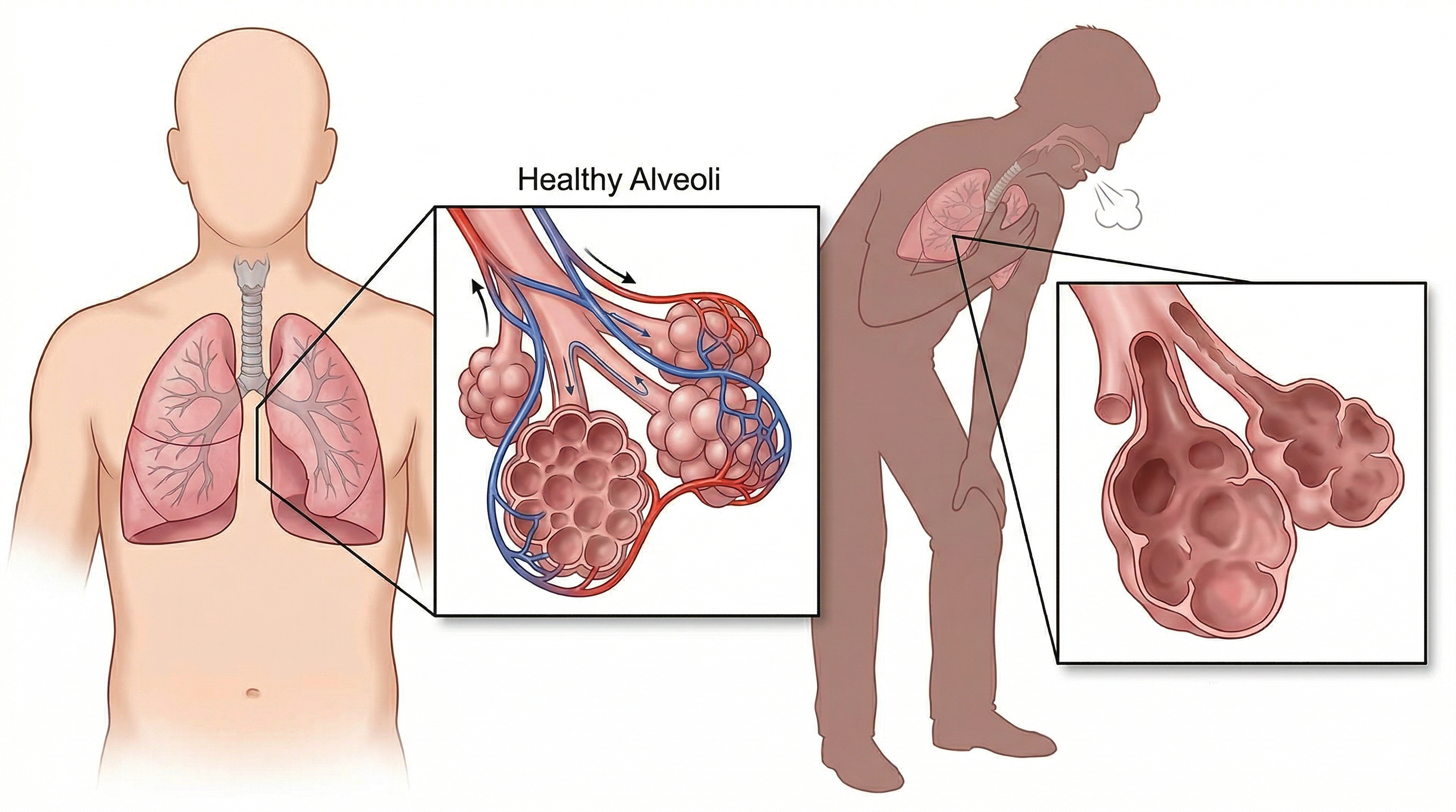 Enfermedad pulmonar obstructiva crónica (EPOC)